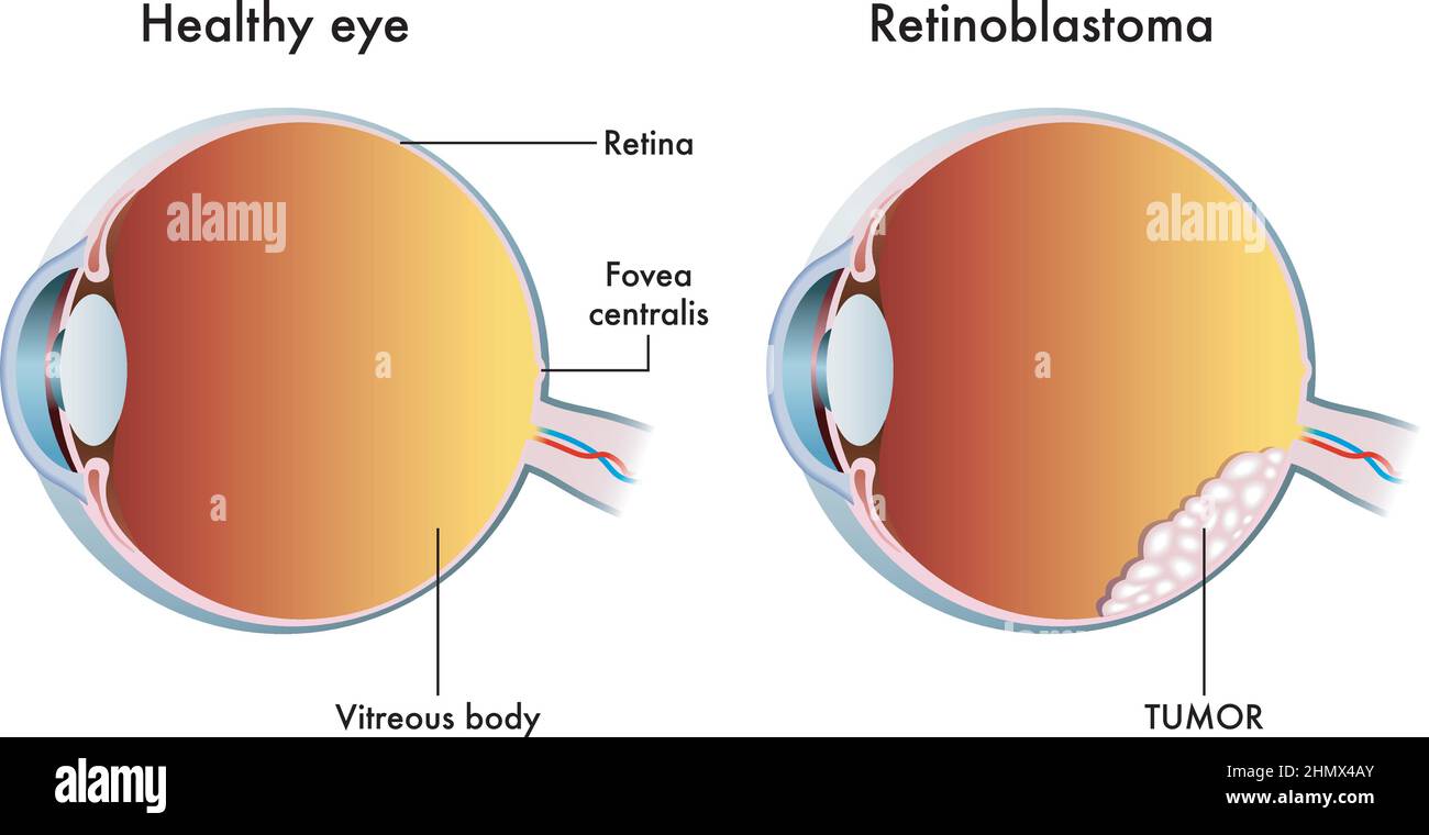 L'illustrazione medica confronta un occhio sano con uno affetto da retinoblastoma. Illustrazione Vettoriale