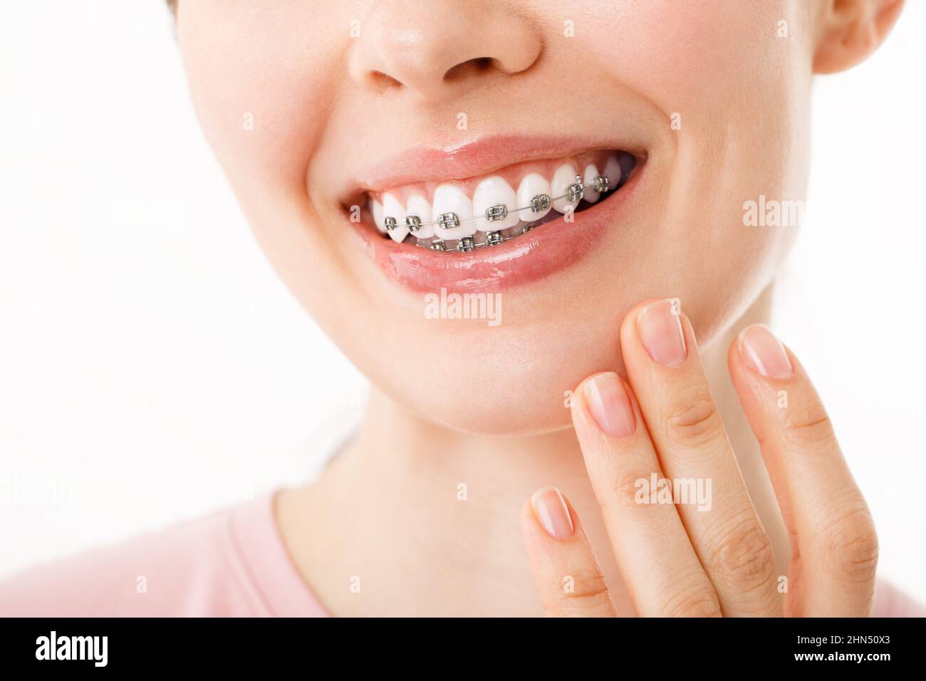 Sorridi con bretelle trattamento ortodontico. Concetto di cura dentale. Bella donna sorriso sano primo piano. Primo piano staffe in ceramica e metallo sui denti Foto Stock