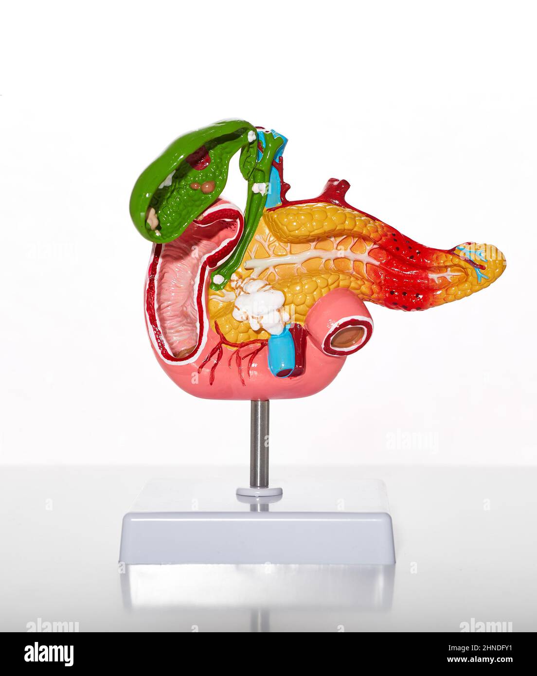 Modello anatomico del pancreas umano e della cistifellea con patologie e malattie per l'educazione medica e biologica, primo piano Foto Stock