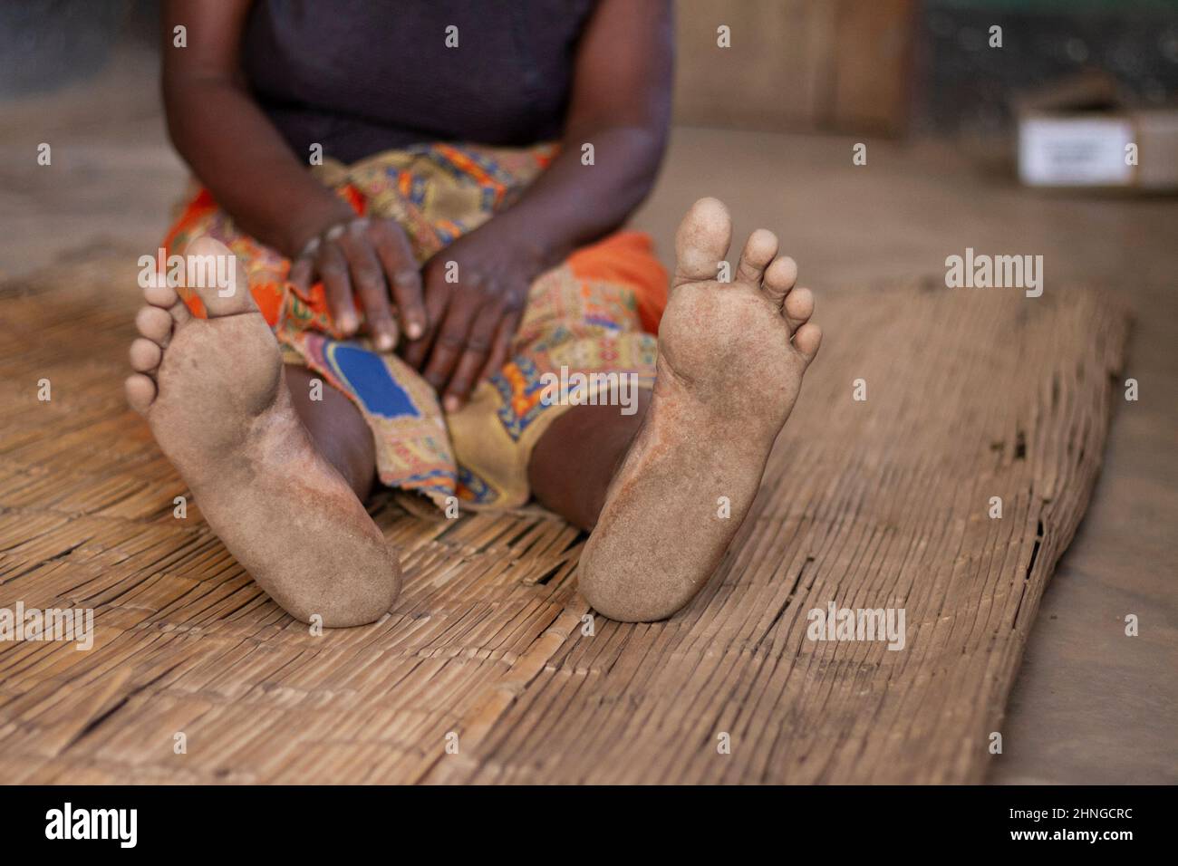 I piedi di Grace Nziza sono visti come lei si siede fuori del suo rifugio temporaneo dopo che la sua casa è stata distrutta dal ciclone ana nel distretto di Nsanje. Ha perso tutto ed è stata lasciata con soltanto i vestiti sulla sua parte posteriore. Malawi. Foto Stock