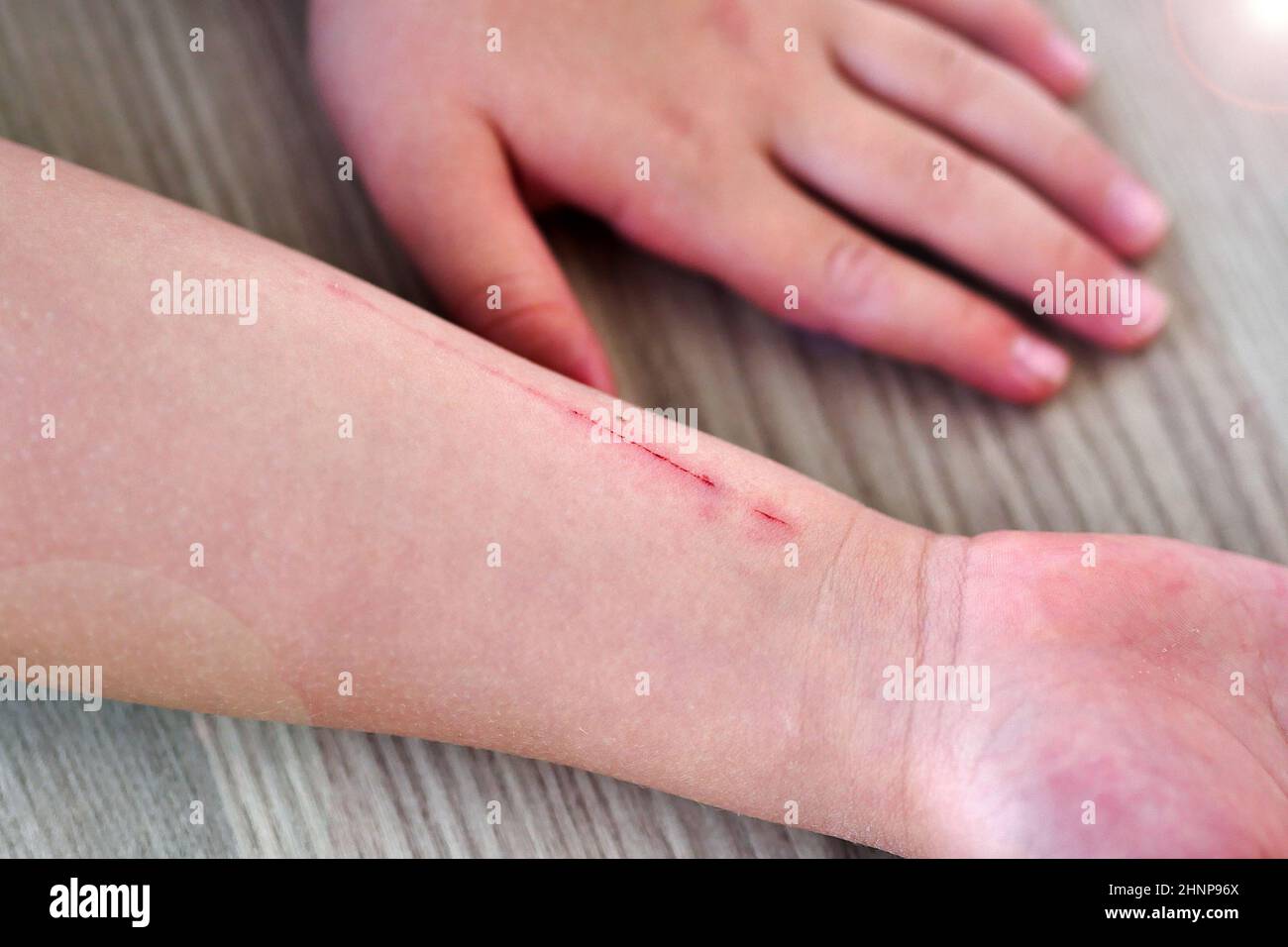 braccio graffiato e ferito di un bambino, lesioni alle braccia, Foto Stock