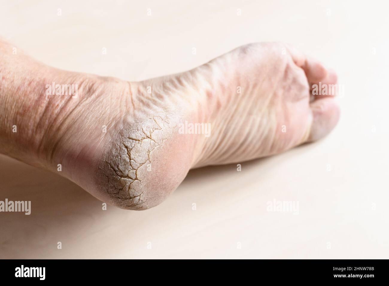 pelle secca morta spaccata sul tallone del piede maschio in primo piano Foto Stock