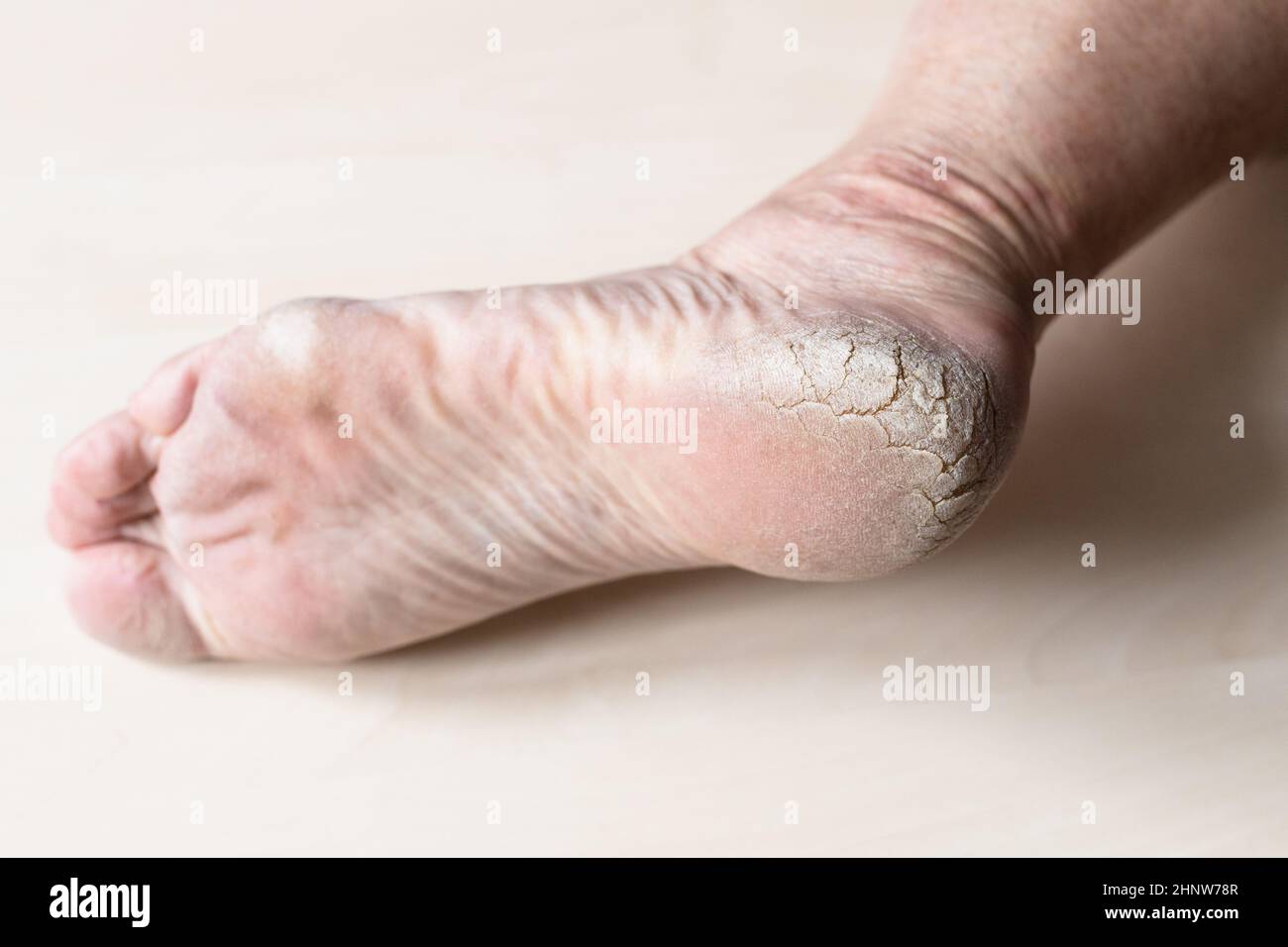 pelle screpolata ruvida sul tallone del piede maschio in primo piano Foto Stock