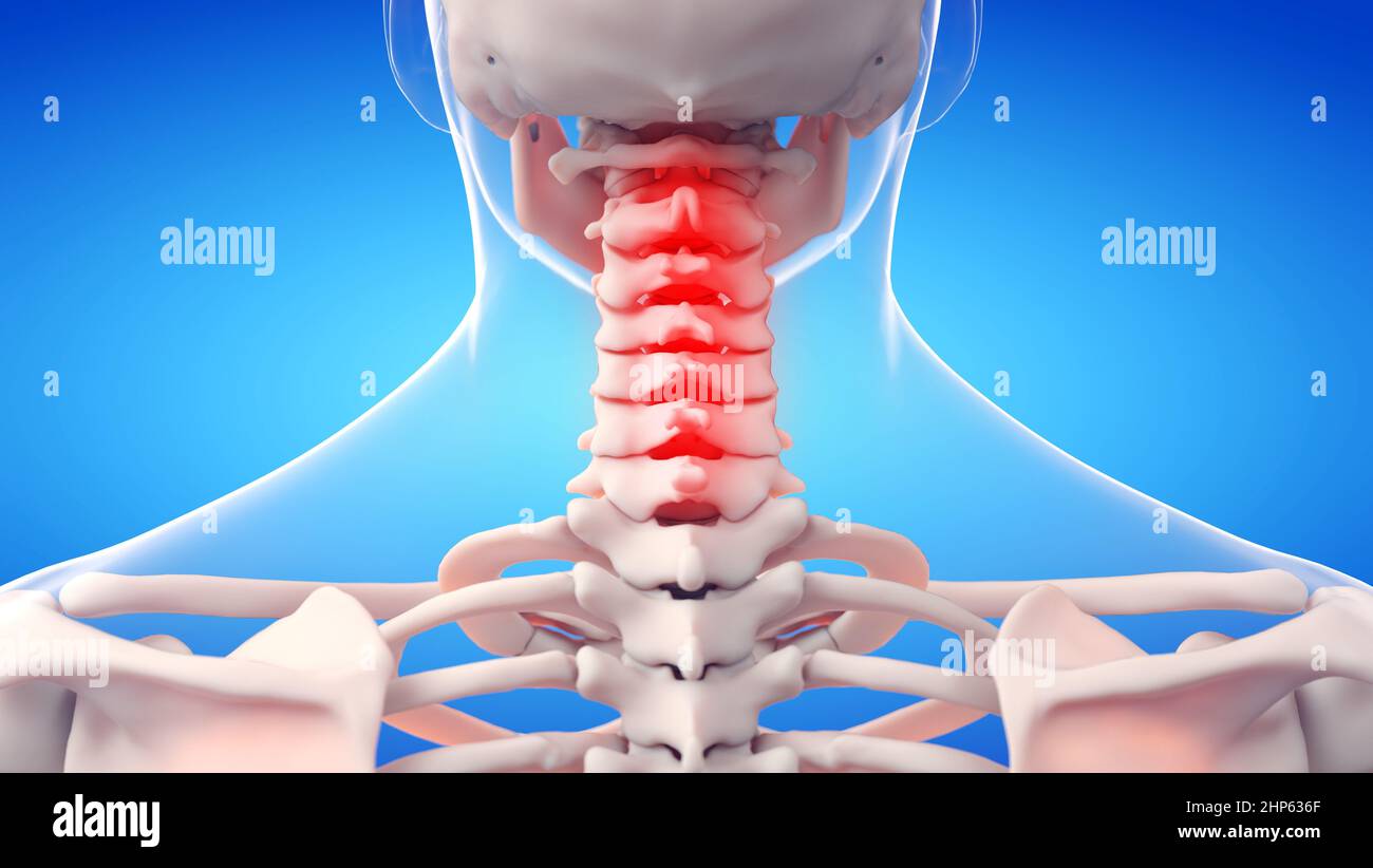 Colonna cervicale dolorosa, illustrazione. Foto Stock