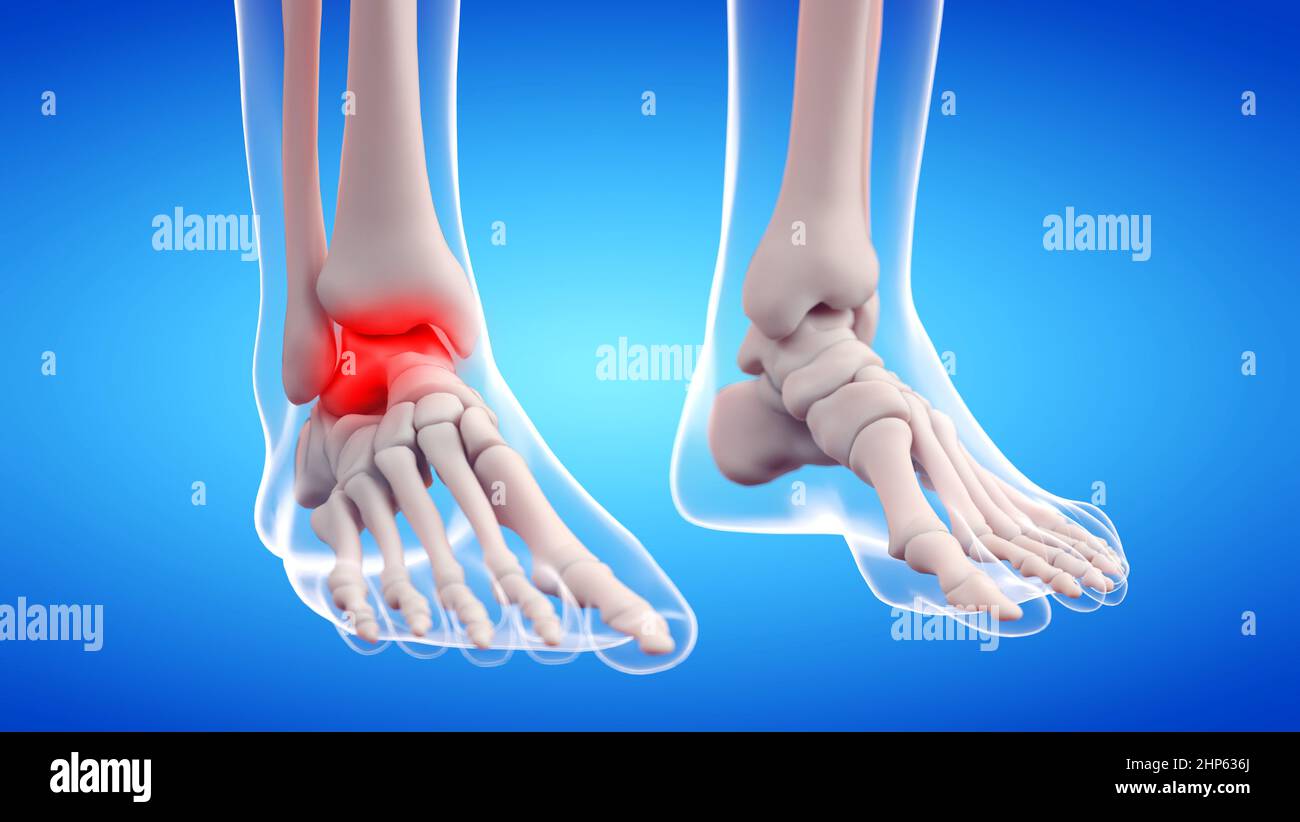 Articolazione dolorosa della caviglia, illustrazione. Foto Stock