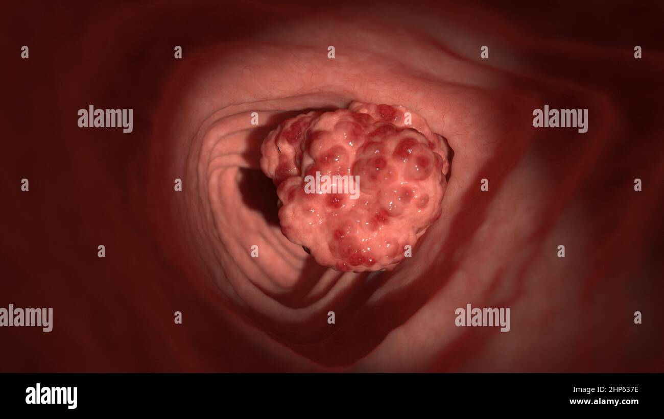 Tumori del colon, illustrazione. Foto Stock