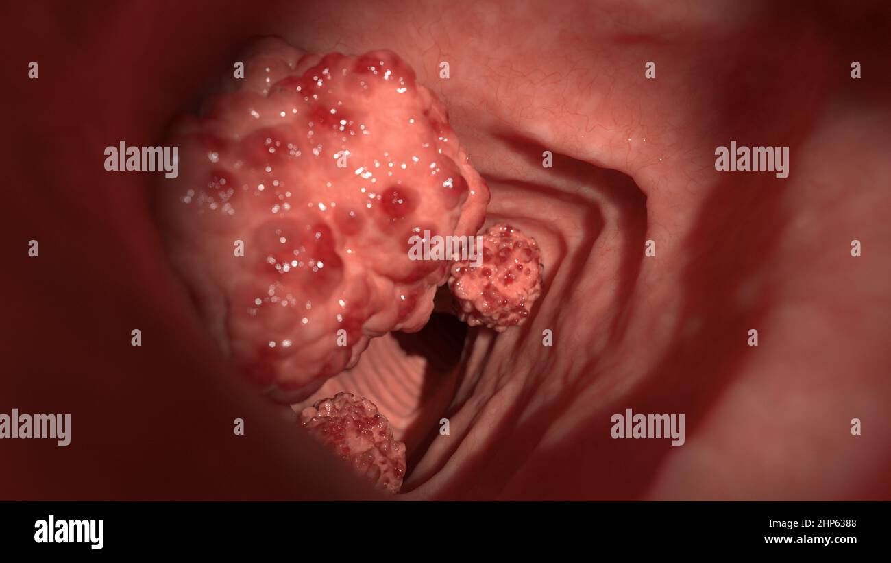 Tumori del colon, illustrazione. Foto Stock