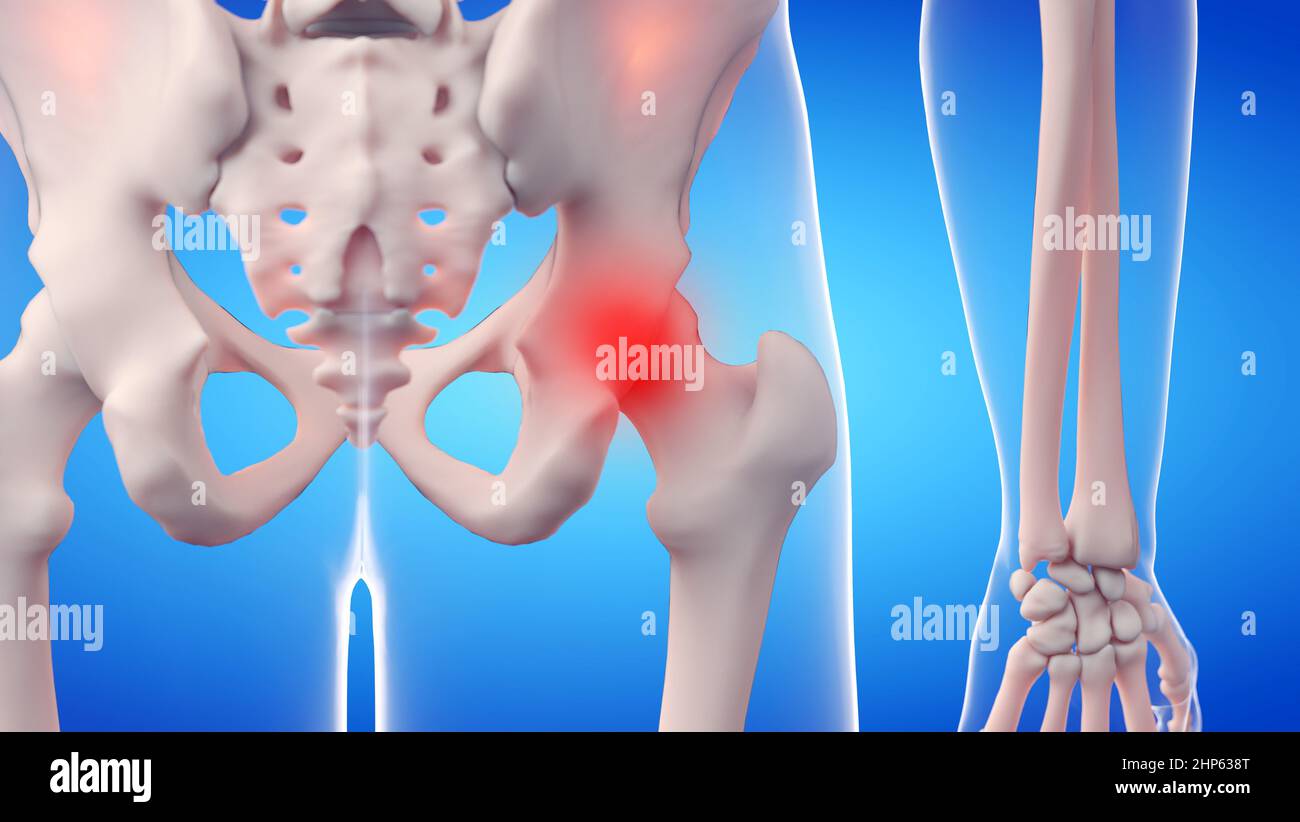 Articolazione dolorosa dell'anca, illustrazione. Foto Stock