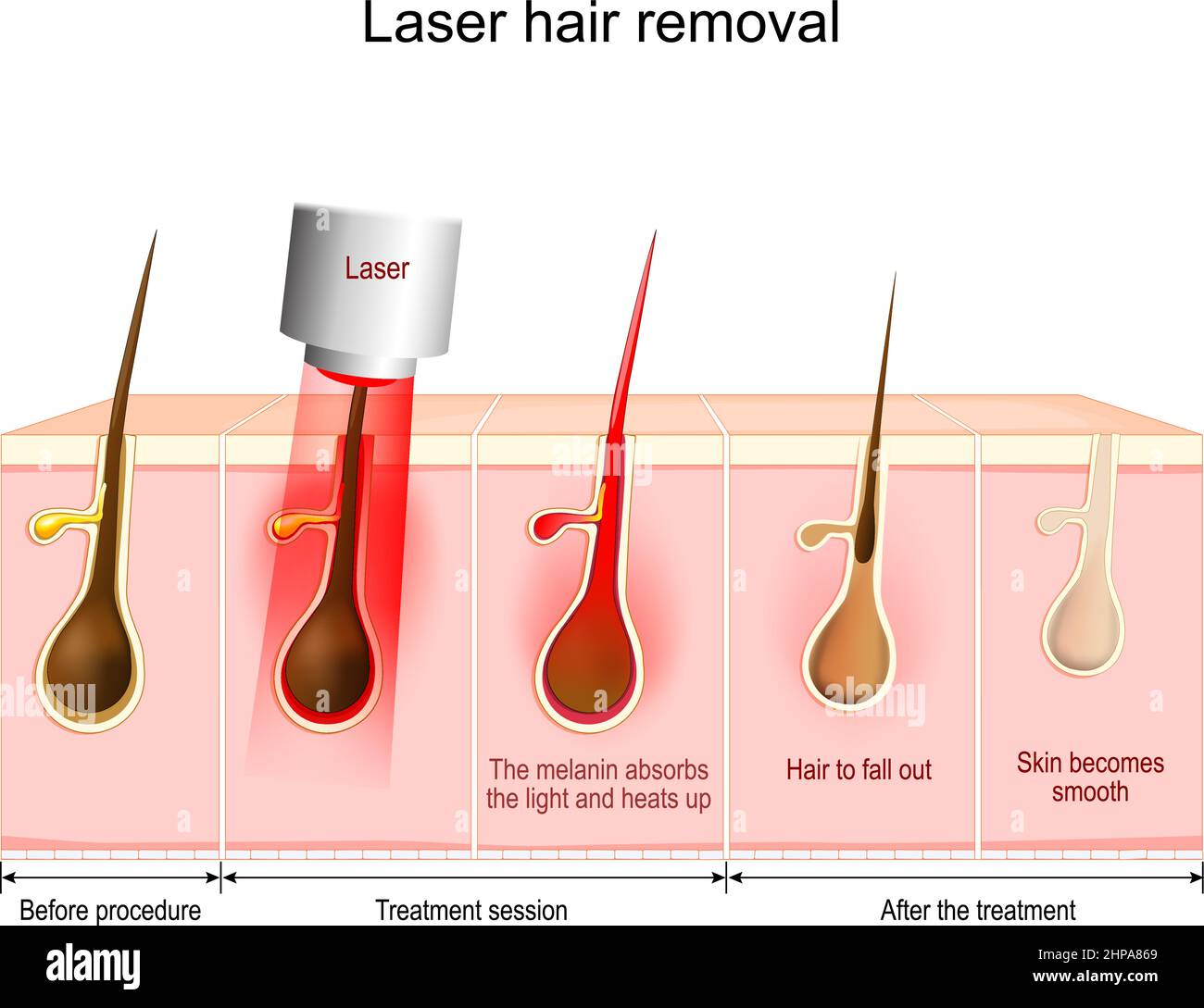 Rimozione dei peli tramite laser. La melanina assorbe la luce e si riscalda, i capelli cadono. Diagramma vettoriale sullo stato della pelle e dei capelli prima della procedura, dopo Illustrazione Vettoriale