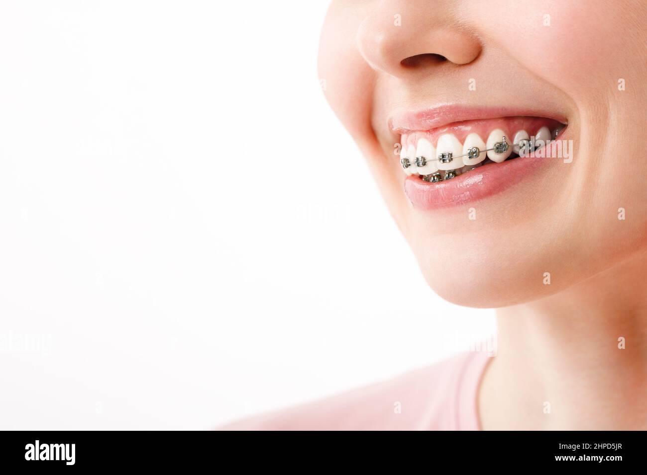 Trattamento ortodontico. Per le cure dentarie concetto. Bella Donna sorriso sano vicino. Primo piano in ceramica e le staffe di metallo sui denti. Bellissima femmina Foto Stock