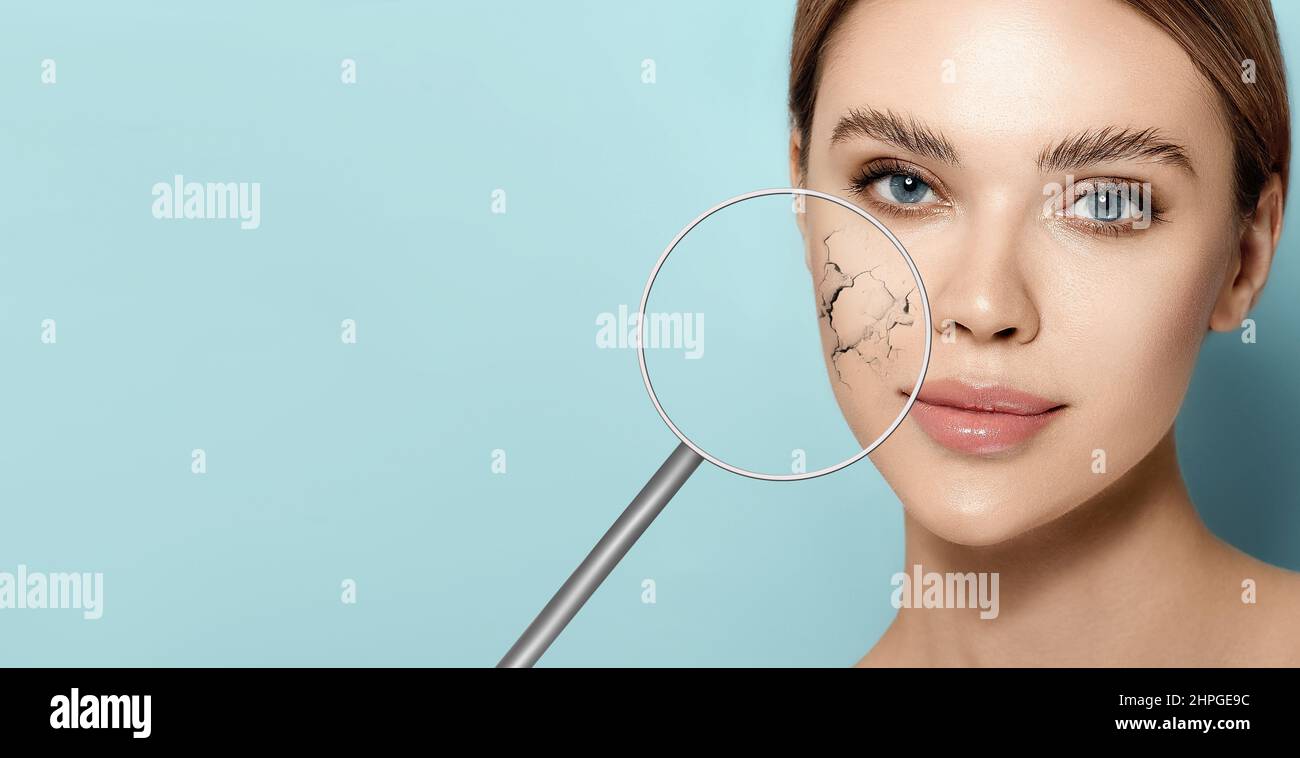 Faccia femminile con pelle secca del viso che mostra pelle disidratata e secca con lente di ingrandimento su sfondo blu. Pelle secca screpolata senza umidificazione Foto Stock