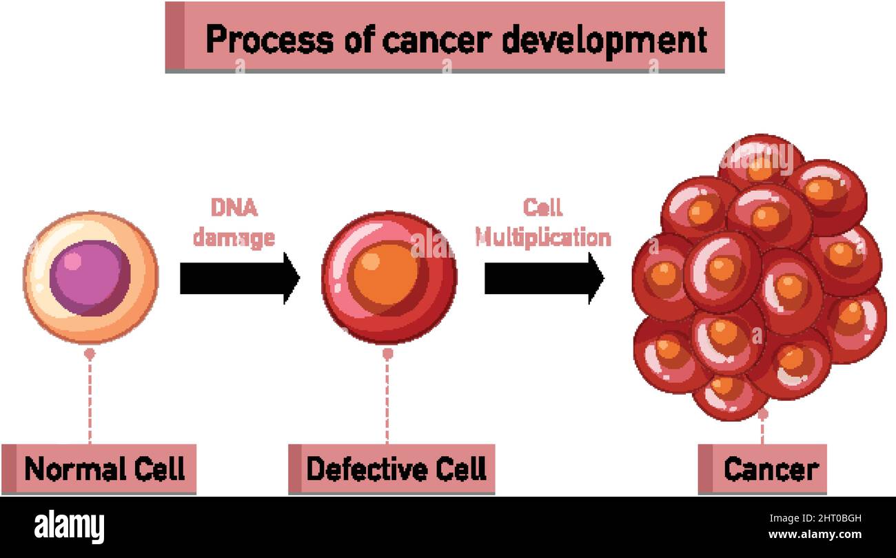 Processo di sviluppo del cancro illustrazione infografica Illustrazione Vettoriale