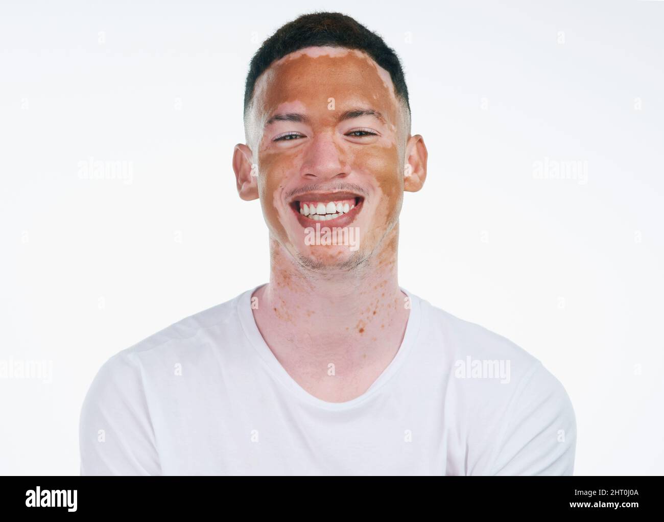 Ciò che ti rende diverso ti rende bello. Ritratto girato di un bel giovane uomo con vitiligo posato su sfondo bianco. Foto Stock