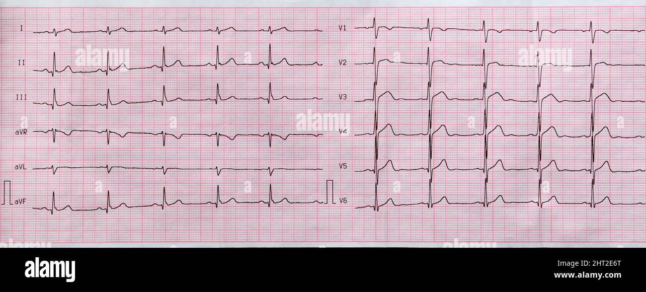 Primo piano elettrocardiografico su carta, cardiologia e assistenza sanitaria Foto Stock