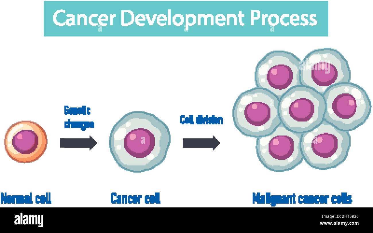 Illustrazione infografica del processo di devlopment del cancro Illustrazione Vettoriale