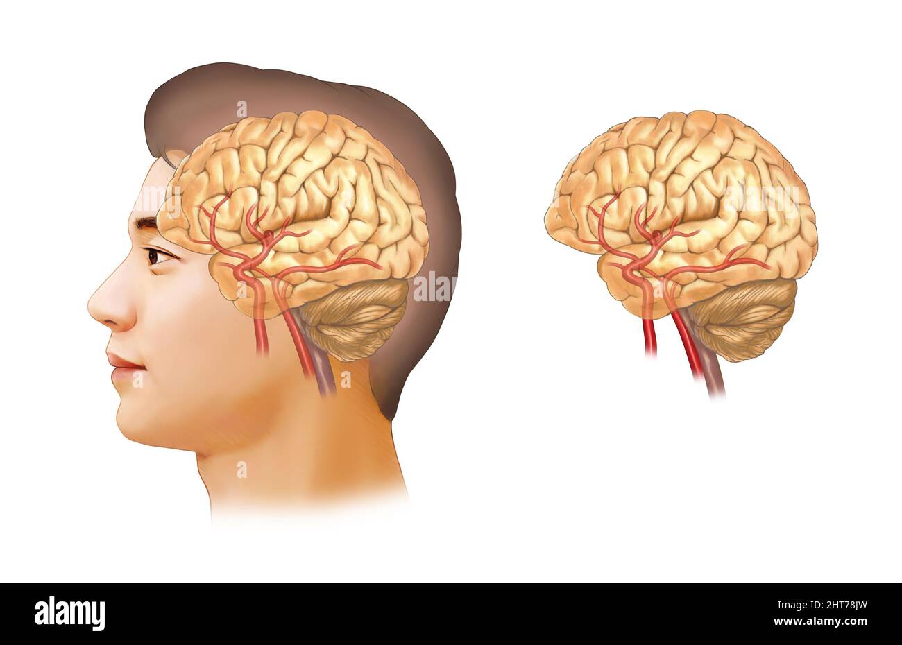 Un'illustrazione realistica dell'anatomia dell'aneurisma cerebrale Foto Stock