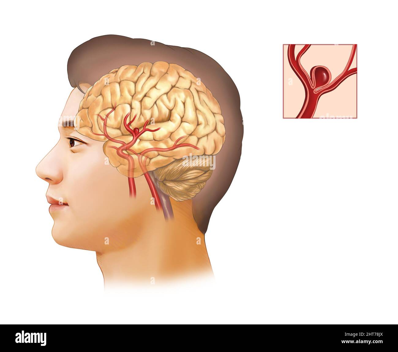 Un'illustrazione realistica dell'anatomia dell'aneurisma cerebrale Foto Stock