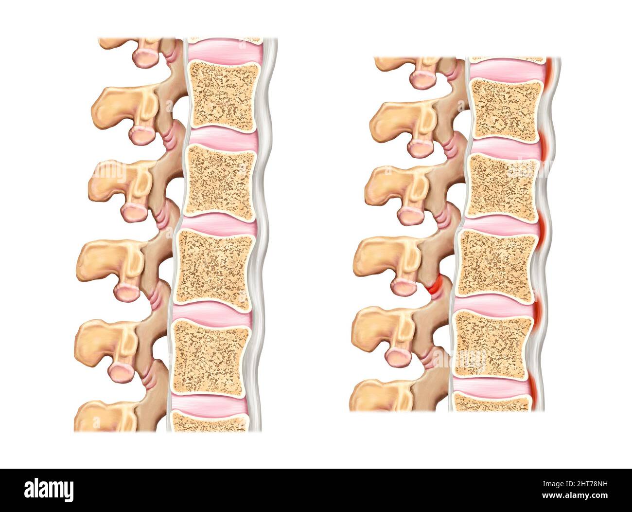 Un'illustrazione realistica dell'anatomia della colonna vertebrale e del disco Foto Stock