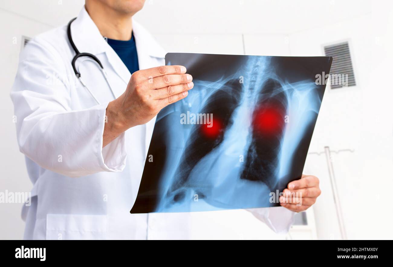 Tumore polmonare o polmonite. L'immagine radiografica del medico di controllo ha un tumore polmonare problematico del paziente o ha una lunga convivenza in ospedale Foto Stock