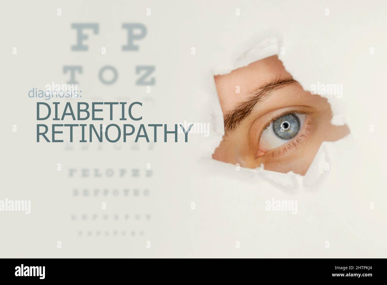Poster della malattia della retinopatia diabetica con grafico di prova dell'occhio e occhio blu.Studio sfondo grigio Foto Stock