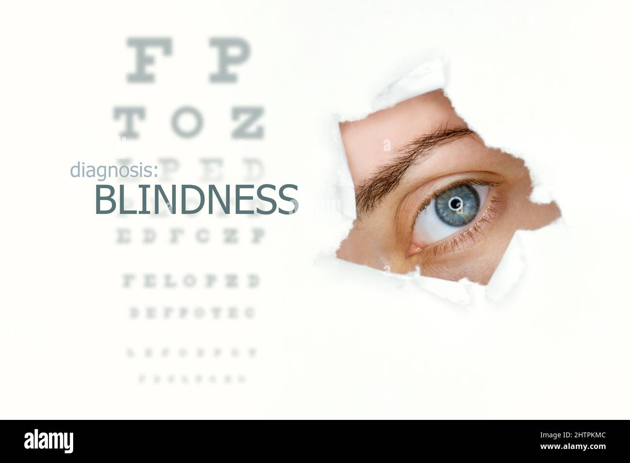 Poster della malattia della cecità con la tabella dei test oculari e l'occhio blu a destra. Isolato su bianco Foto Stock