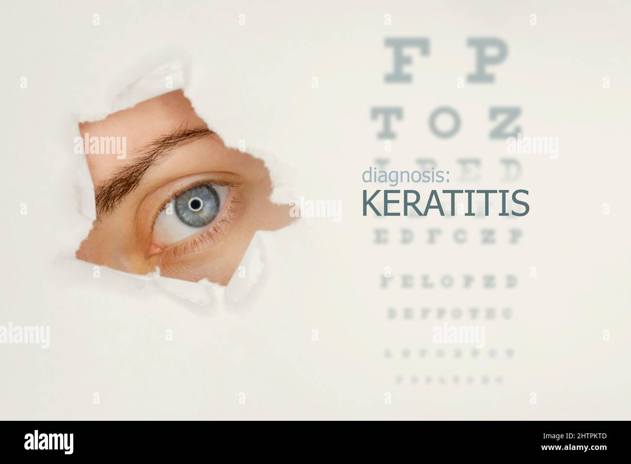 Poster della malattia di cheratite con diagramma di prova dell'occhio e occhio blu. Sfondo grigio studio Foto Stock