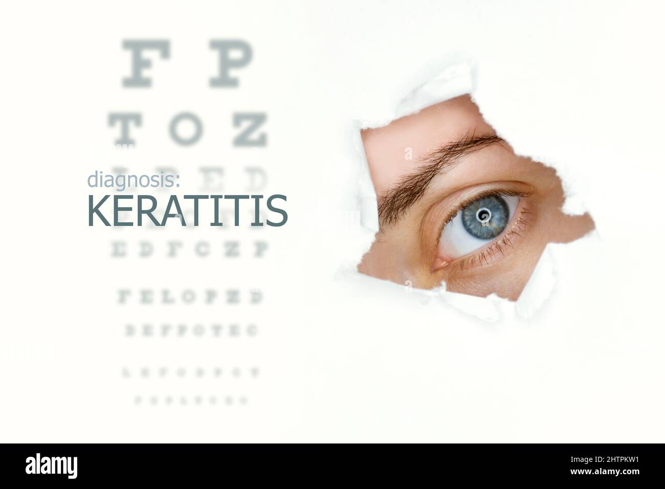 Poster della malattia di cheratite con diagramma di prova dell'occhio e occhio blu. Isolato su bianco Foto Stock