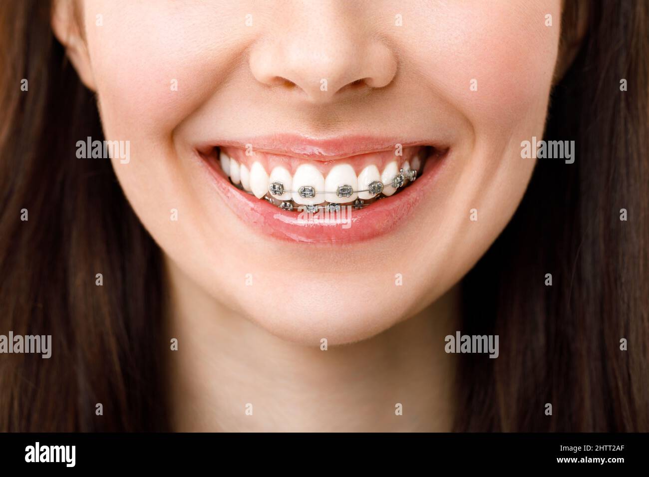 Trattamento ortodontico. Concetto di cura dentale. Bella donna sorriso sano primo piano. Primo piano staffe in ceramica e metallo sui denti. Bellissimo sorriso. Foto Stock