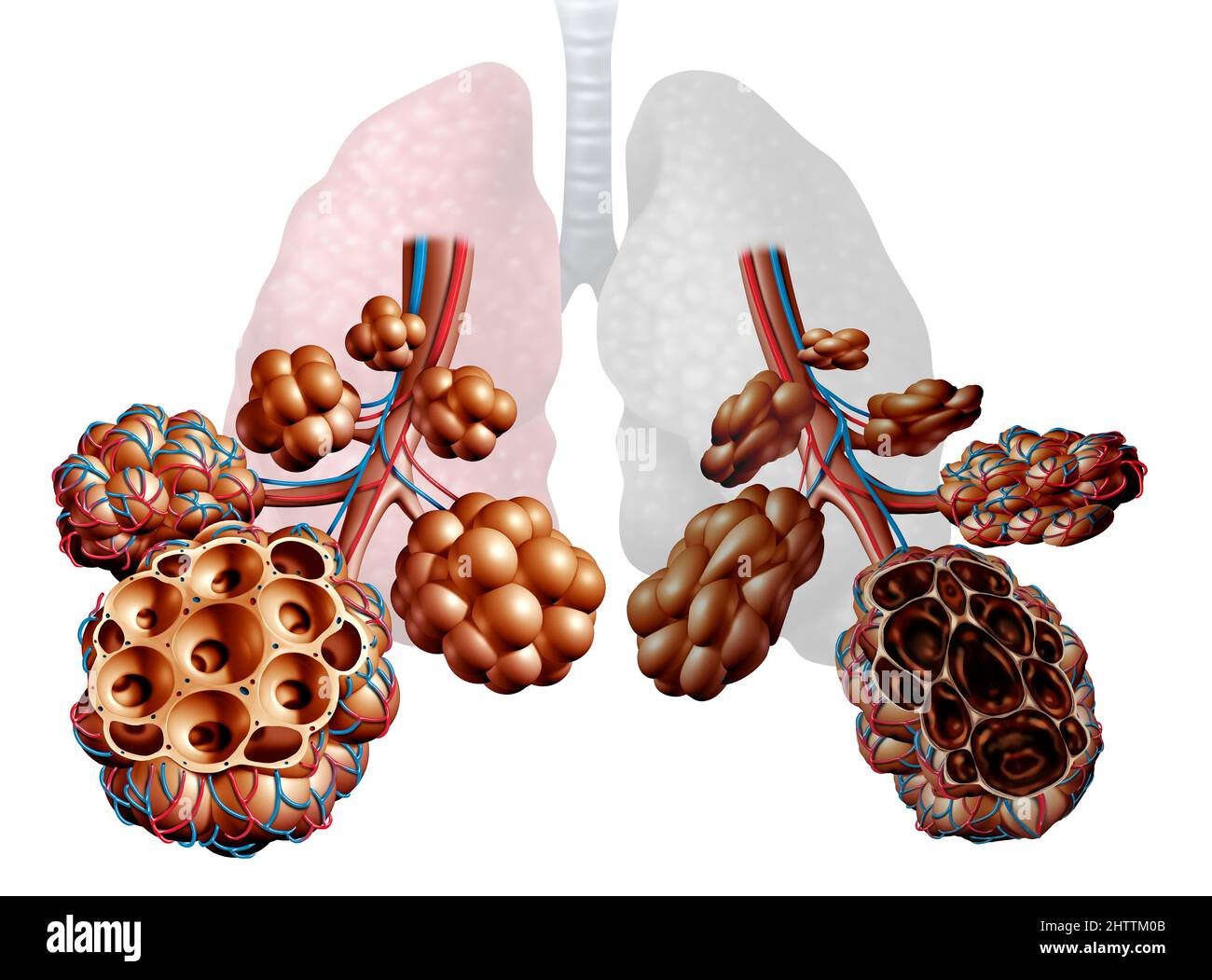 Enfisema come mancanza di respiro, disturbo polmonare come una malattia di BPCO cronica ostruttiva polmonare concetto medico come bronchioli e alveoli. Foto Stock