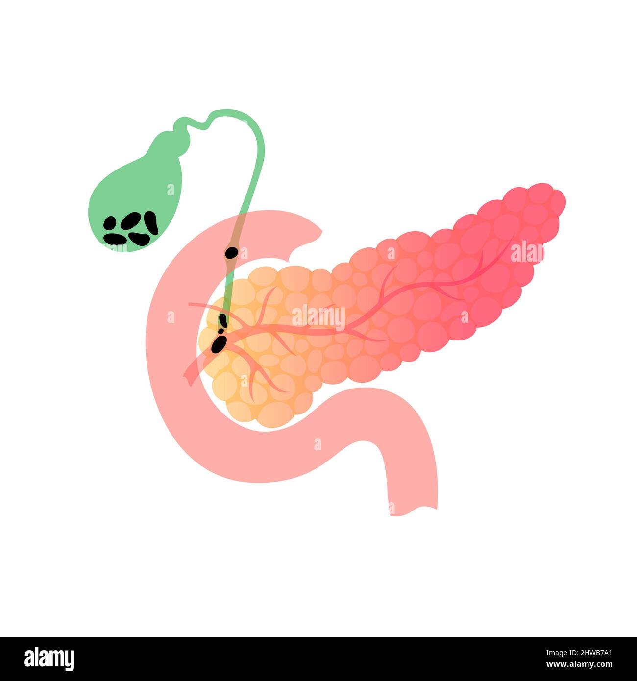 Pancreas e cistifellea con pietre, illustrazione Foto Stock