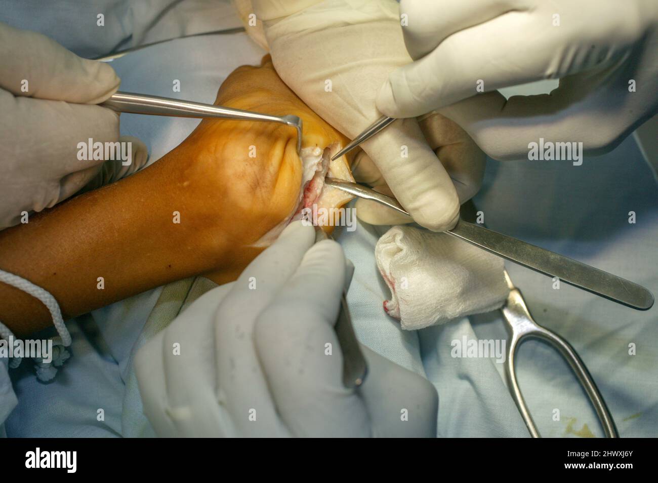 I chirurghi espongono inoltre i tendini peroneo-brevis e peroneo-longus dal tessuto molle circostante. Foto Stock