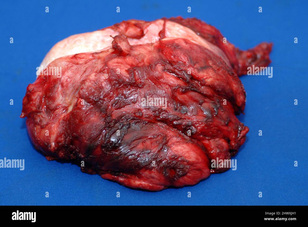 Nella figura è illustrato il tumore appartenente all'uomo sottoposto a chirurgia per rimuovere il fibrosarcoma. Il fibrosarcoma (sarcoma fibroblastico) è un mesenchimale maligno Foto Stock