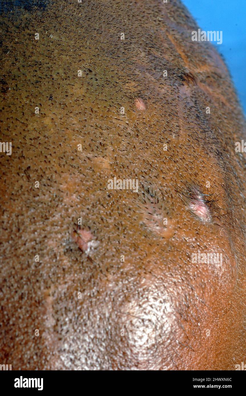 Actinomicetoma sulla testa di un maschio di 36 anni. Il micetoma è una malattia non comune riscontrata nei tropici. È un'infezione cronica localizzata della Foto Stock
