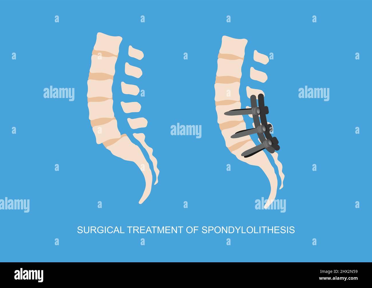 Illustrazione vettoriale della vertebra lumbosacrale o della spondilolite scivolata e fissazione chirurgica della colonna vertebrale. Illustrazione vettoriale. Illustrazione Vettoriale
