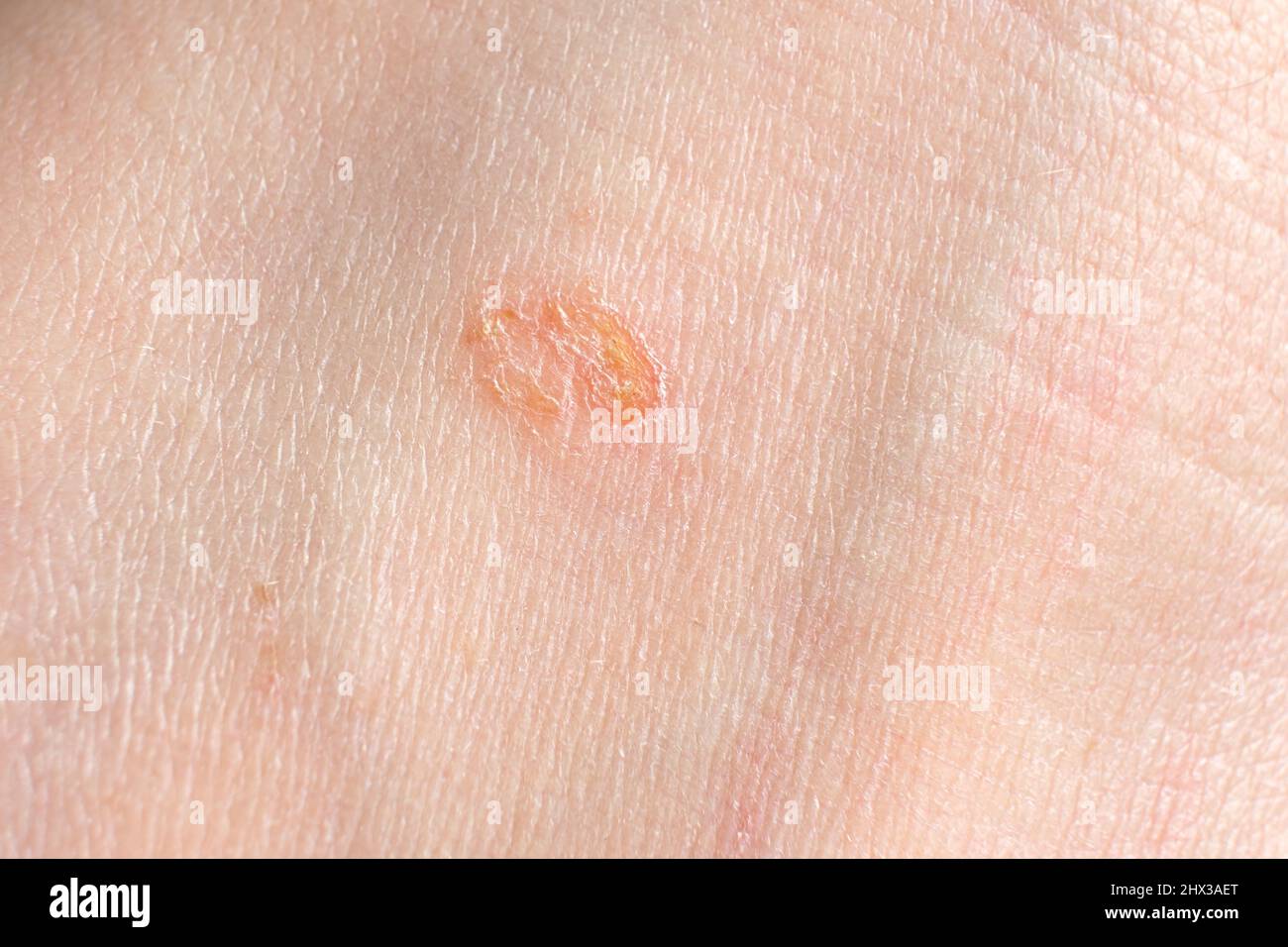 Streptoderma - dermatite sulla pelle umana, macchia rotonda rossa, macro fotografia, infiammazione batterica Foto Stock