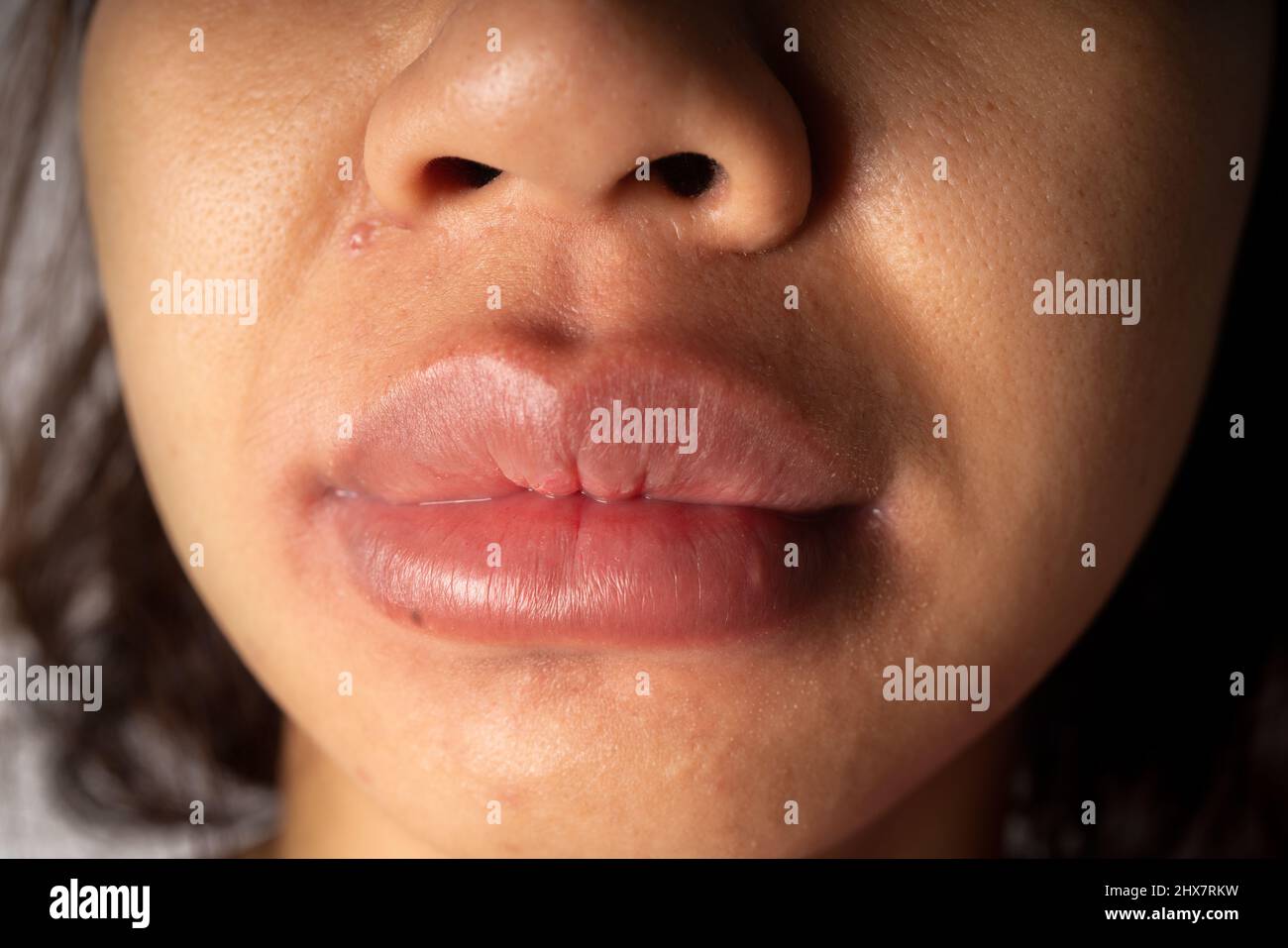 La bocca gonfia della donna con un'eruzione cutanea dovuta ad allergie alimentari, può essere allergica al latte di vacca, ai frutti di mare, al burro di arachidi, ai gamberetti o ai pesci Foto Stock