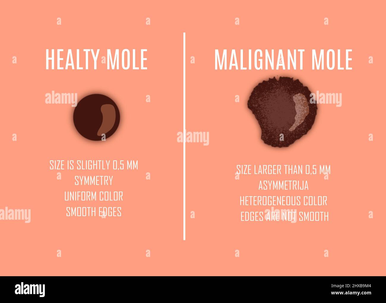 Confronto tra mole healty e mole pericolose. Rischio di cancro della pelle. Illustrazione Foto Stock
