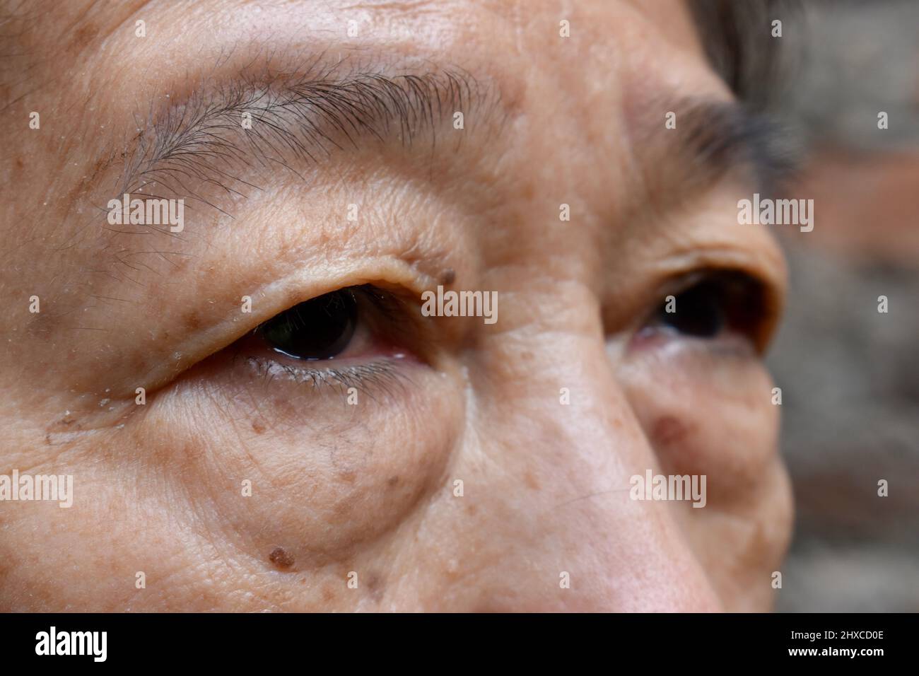 Sacco grasso prominente sotto l'occhio della donna anziana asiatica. Primo piano. Foto Stock