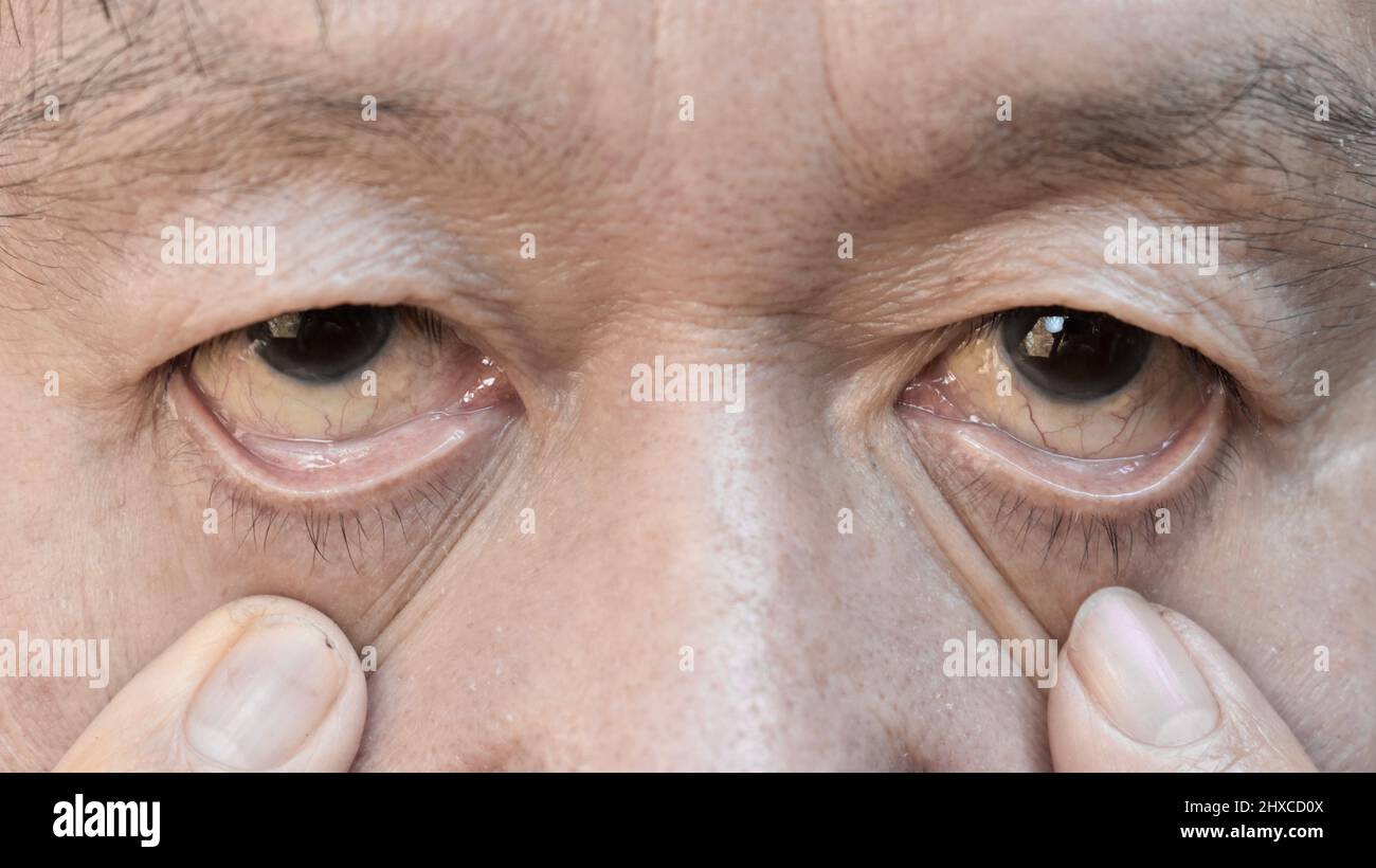 Pelle pallida dell'uomo anziano asiatico. Segno di anemia. Pallore alla palpebra. Foto Stock