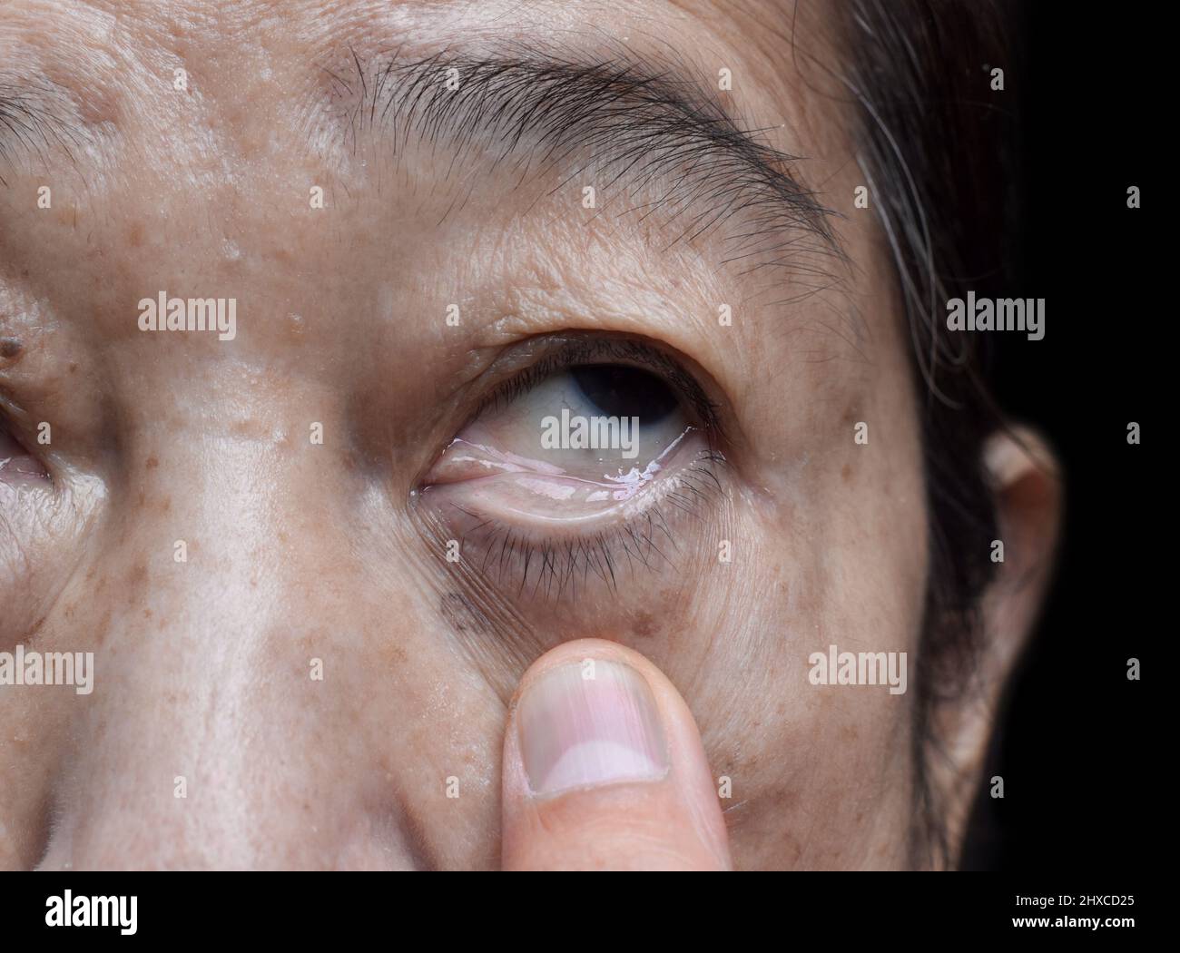 Pelle pallida di una donna anziana asiatica. Segno di anemia. Pallore alla palpebra. Foto Stock