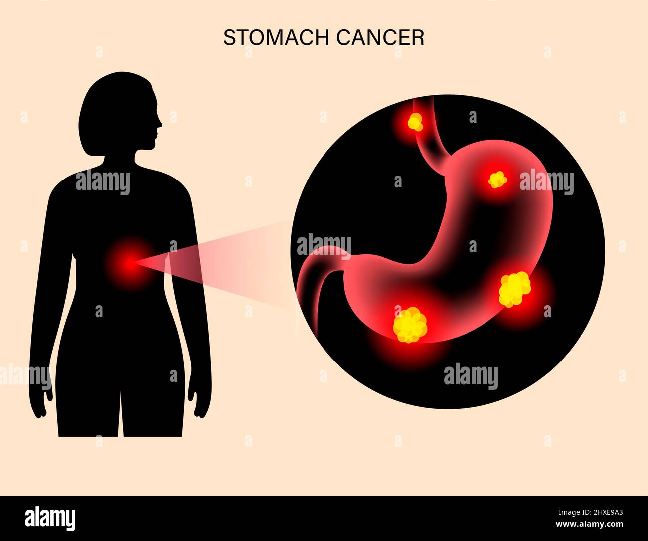 Il cancro dello stomaco, illustrazione Foto Stock
