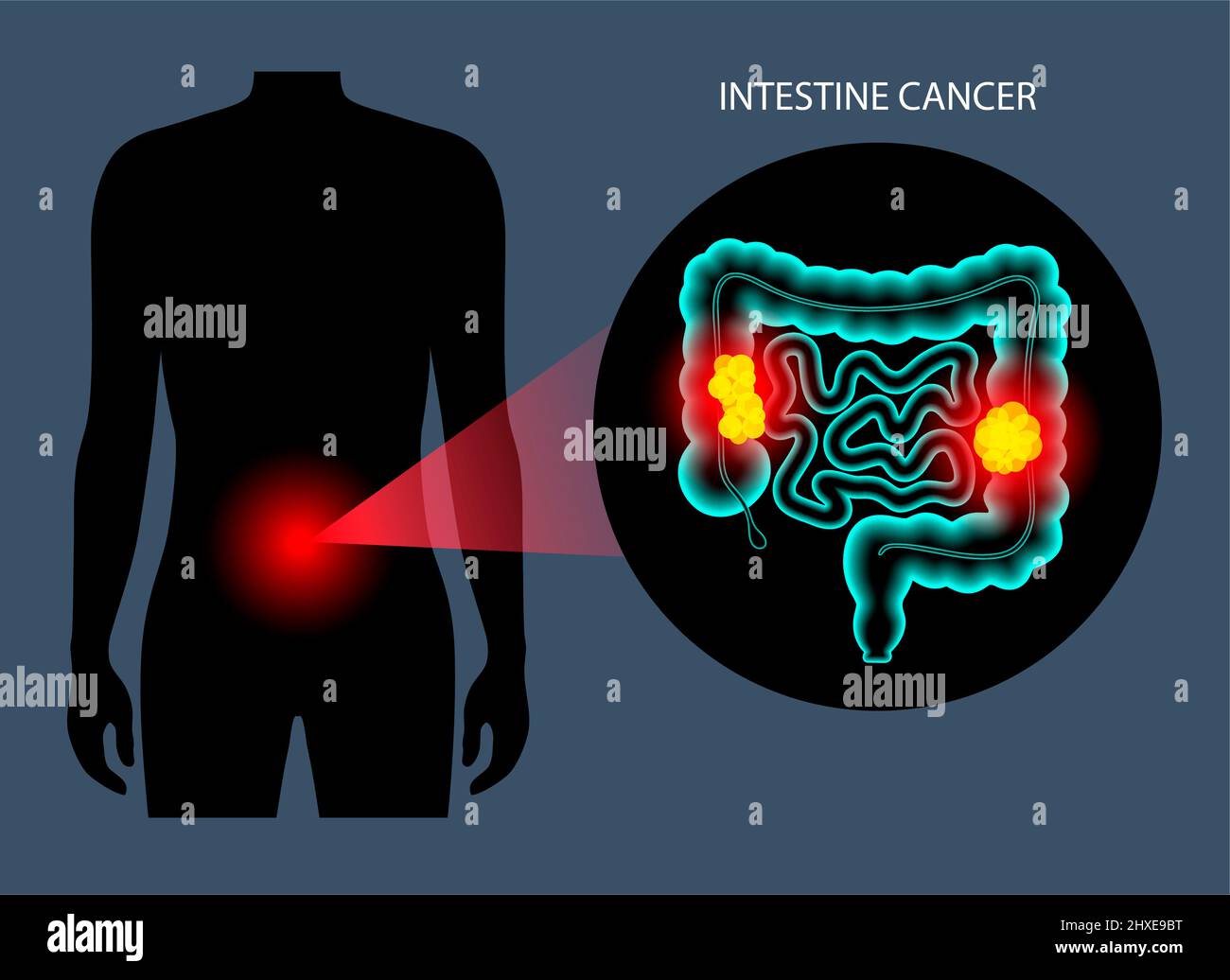 Cancro colorettale, illustrazione Foto Stock