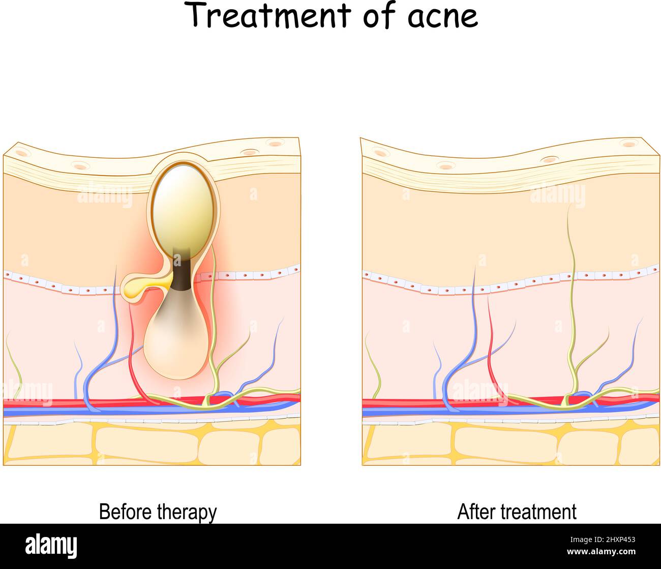 Trattamento dell'acne. Prima e dopo la terapia. Sezione trasversale della pelle. Poster vettoriale Illustrazione Vettoriale