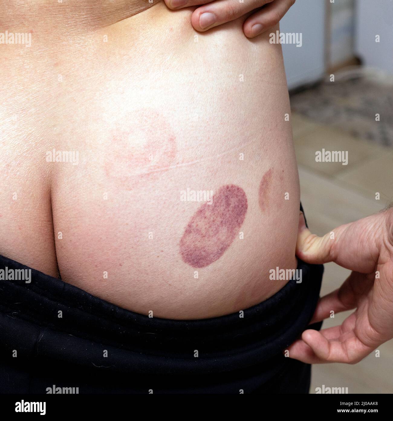 Uomo con emicampaggi massaggiati dopo aver preso la terapia di cupping. Foto Stock