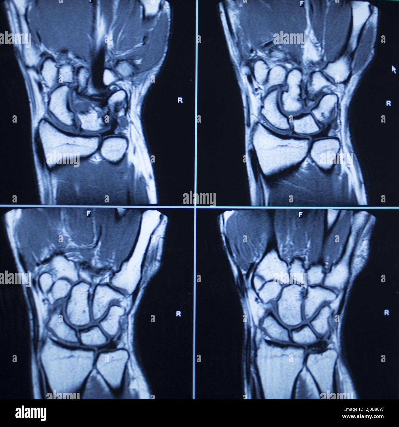 Il test di scansione MRI provoca lesioni al polso Foto Stock