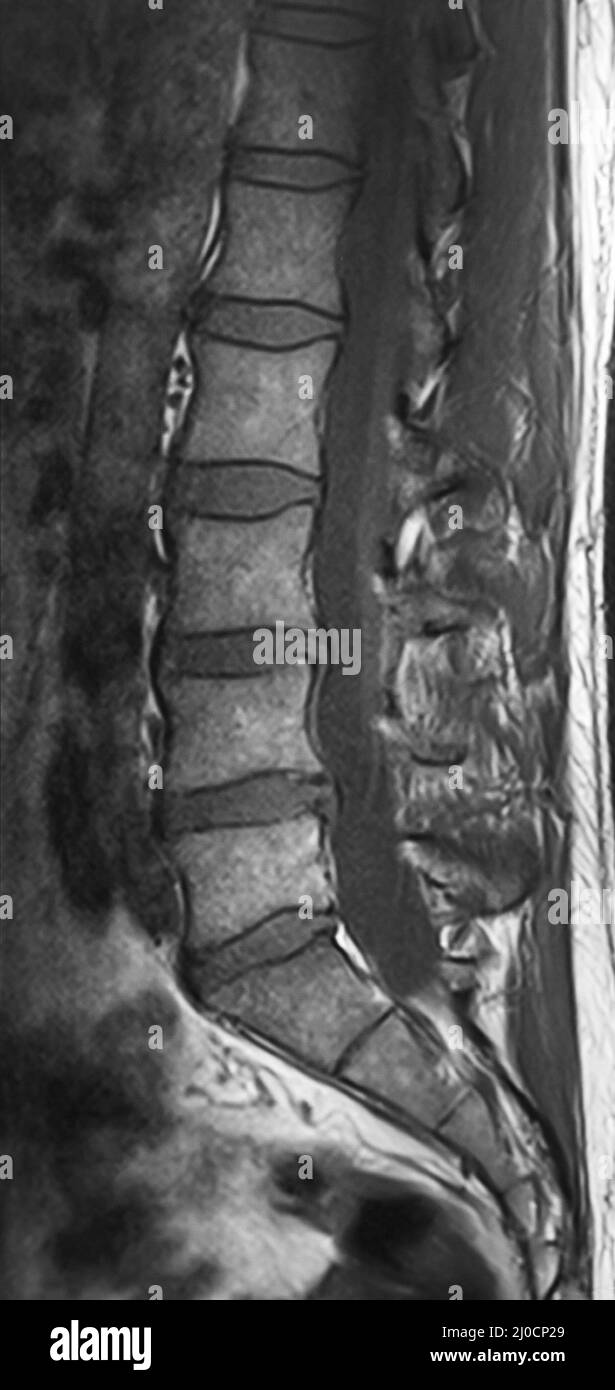 Le scansioni TC della colonna vertebrale umana Foto Stock