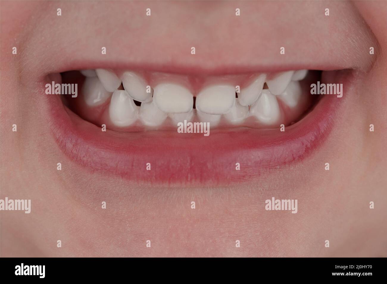 Primo piano di denti sani del latte Foto Stock