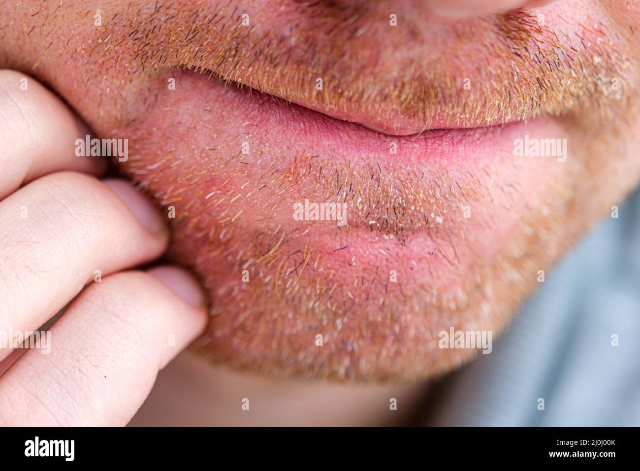 Uomo che gli graffia il volto. Dermatite seborroica o eczema su faccia umana adulta isolato close up. Foto Stock
