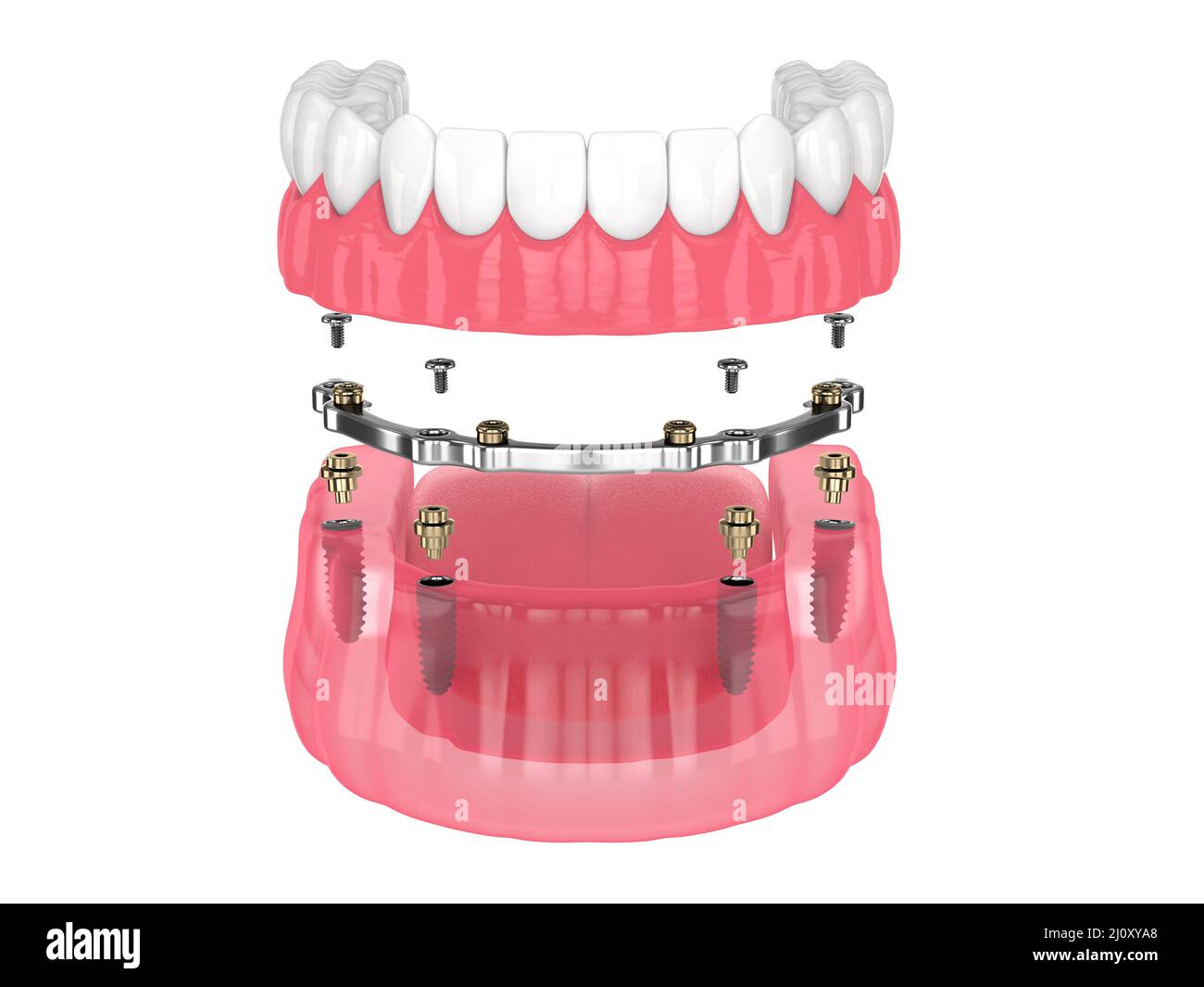 Installazione di overdenture rimovibile con ritenuta a barra supportata da impianti su backgroud bianco Foto Stock