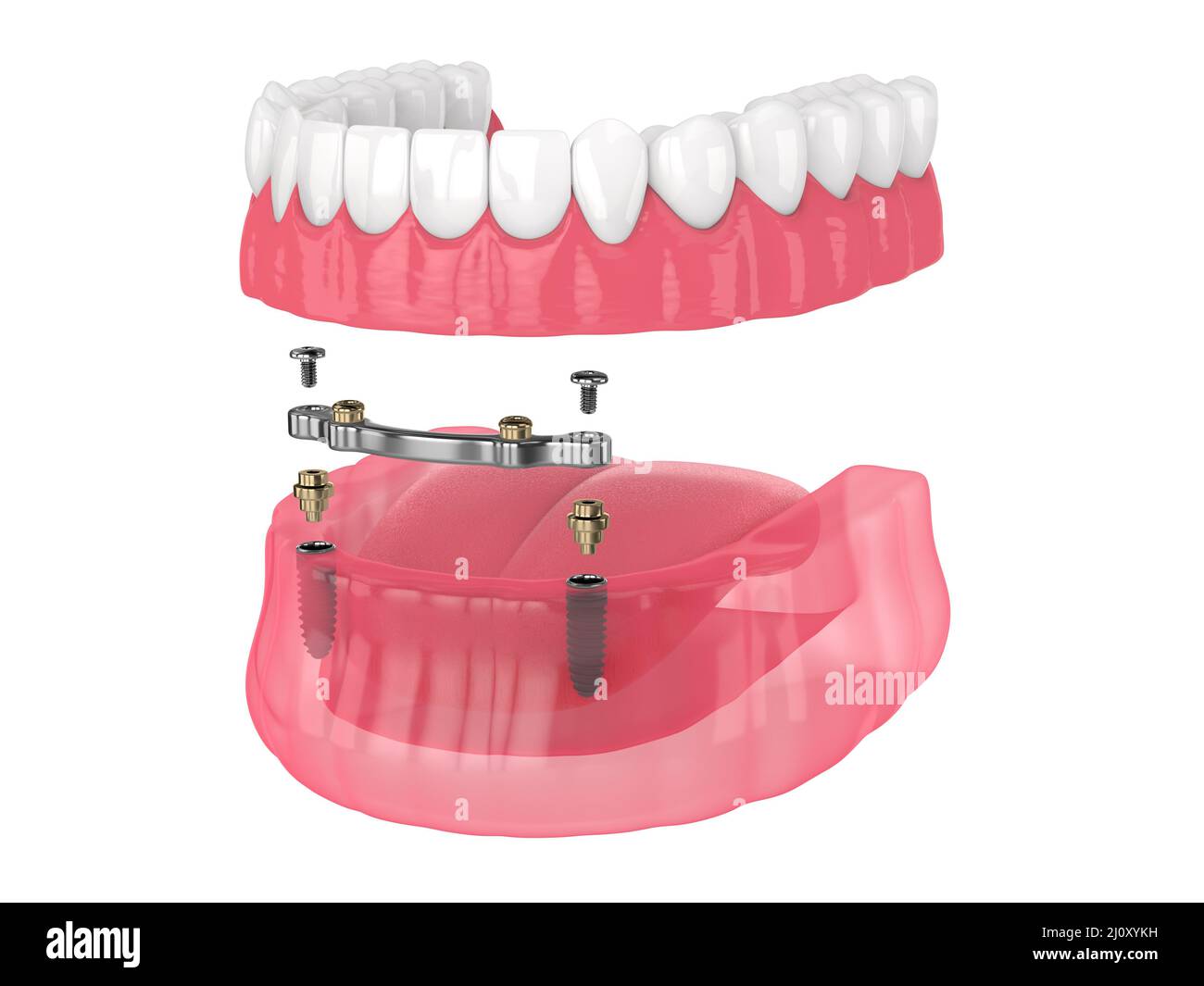 Installazione di overdenture rimovibile con ritenuta a barra supportata da impianti su backgroud bianco Foto Stock